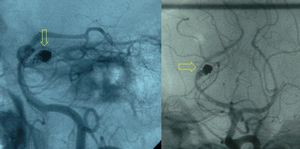 혈관조영술에서 부분적으로 코일링된 동맥류(노란색 화살표)와 후대뇌동맥의 잔여 동맥류 낭이 보인다. 이 환자는 지주막하 출혈로 처음 치료받은 34세 여성이었다.