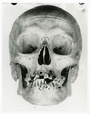 찰스 기토의 두개골은 국립 건강 및 의학 박물관 컬렉션에 보관되어 있다. 40세에 진행된 충치에 주목하라.