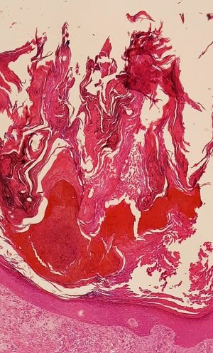 현미경 사진은 이형성이 없는 피부의 현저한 과다 각화증을 보여줍니다. H&E 염색.