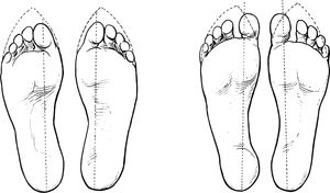 신발의 형태와 발에 미치는 영향. 하이힐과 같이 앞코가 좁고 굽이 높은 신발은 발 변형을 유발할 수 있다.