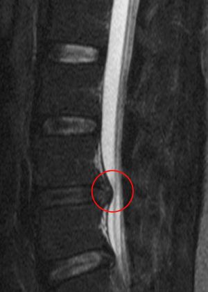 추간판 헤르니아(MRI): 표시된 부분이 압박된 신경근
