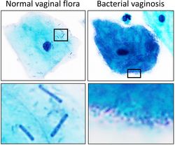 정상적인 질 내 세균총과 세균성 질염을 Pap 염색으로 비교. 정상적인 질 내 세균총 (왼쪽)은 주로 막대 모양의 락토바실리인 반면, 세균성 질염 (오른쪽)에서는 다양한 종의 박테리아가 과도하게 증식한다.