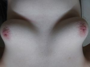 23세 여성의 3등급 함몰 유두