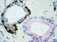 PIN-4 칵테일을 사용하여 양성선(왼쪽)과 전립선 선암종(오른쪽)의 PIN-4 염색. 선암종에는 기저 상피 세포가 없다(p63, CK-5 및 CK-14로 어두운 갈색으로 염색됨). 또한 PIN-4 염색 샘플에서 선암종 세포는 일반적으로 붉은색 세포질을 나타낸다(AMACR로 염색됨).