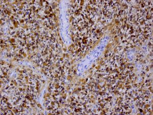 CNS WHO 등급 4등급 별세포종에서 변이된 IDH1 단백질 발현. IDH1 R132H 변이를 표적으로 하는 마우스 단클론 항체를 사용한 면역조직화학 염색.