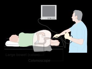 대장내시경 시술 다이어그램