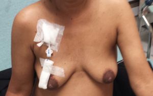 혈액 투석용 퍼머카테터