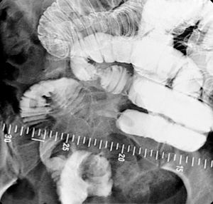 소장 협착을 보여주는 이중 조영 기법의 장액 주입술