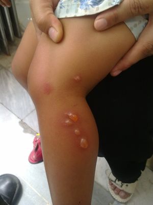 덩굴옻나무 접촉 1일 후 3세 여아에게 발생한 접촉 피부염