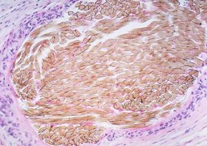 나일론 봉합사에 대한 육아종 반응
