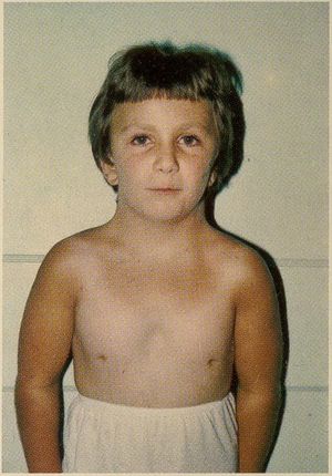 터너 증후군을 앓는 소녀