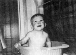 터너 증후군을 앓는 여성 유아. 넓은 가슴과 작은 턱에 주목