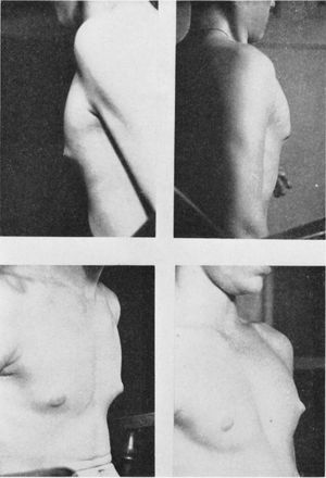 사춘기를 겪는 소년의 여성형유방증