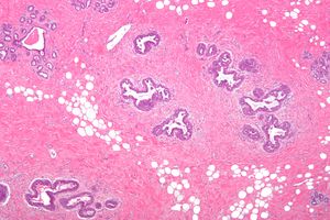 여성형유방증 증식 - 낮은 배율