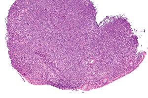 위 MALT 림프종 병변 조직(HE 염색) 중간 확대