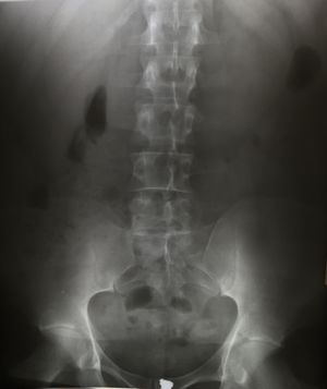 요추의 전후 방사선 사진