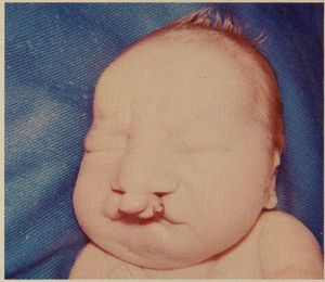 파타우 증후군을 앓는 영아