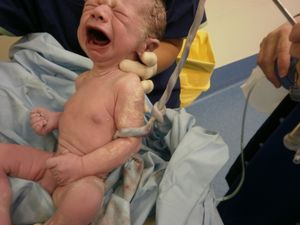 신생아의 탯줄 매듭