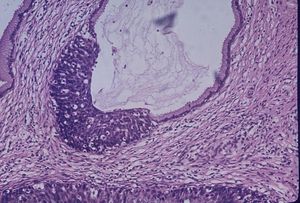 상피 이형성증 고등급 부위를 보여주는 자궁 경부 샘의 현미경 이미지