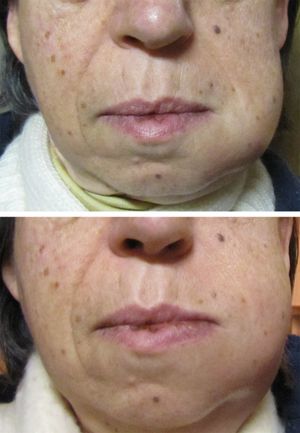 치아에서 시작되어 협측 공간으로 퍼진 농양. 위: 이틀째 볼의 변형. 아래: 사흘째 변형.