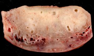 자궁 절제술 표본의 벽을 가로지르는 단면으로, 만성 골반 통증과 비정상적인 자궁 출혈을 호소한 30세 여성의 표본이다. 자궁내막 표면은 이미지 상단에 있고, 장막은 하단에 있다.