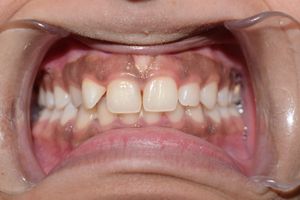 22세 비흡연 여성 환자의 잇몸 과다 색소 침착