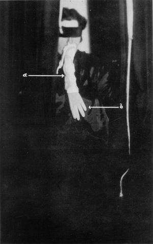 헬렌 던컨과 치즈천, 고무 장갑으로 만들어진 것으로 분석된 엑토플라즘