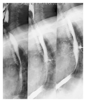 바륨 연하 검사에서 보이는 흡인