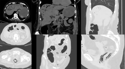 CT 영상, 창자공기증과 장간막 및 간정맥 내 가스 관찰