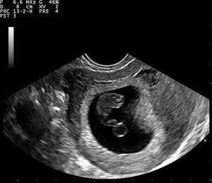 단일 자궁내 임신, 첫 번째 삼 분기. 임신낭(초음파에서 검게 나타남)과 태아 극, 난황낭(태아 극 아래의 원형 구조)이 보인다.