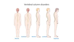 척추후만증(가장 오른쪽에)은 척추측만증 및 전만증을 포함한 다른 척추 질환과 비교하여 보여준다.