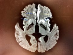 자기 공명 영상(MRI)을 통해 뇌에서 프라이온 단백질의 명백한 침전을 볼 수 있다.