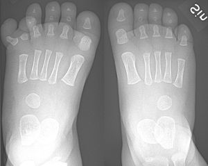 8.5개월 된 남성의 오른발 작은 발가락 오른쪽에 중복된 상태. 다섯 번째와 여섯 번째 발가락이 다섯 번째 중족골과 관절을 형성하는 것으로 보이며, 원위부로 약간 넓어졌다. 중복된 발가락은 거의 정상적인 성장을 보인다. 다섯 번째 발가락은 약간의 내반 변형을 보이며, 여섯 번째 발가락은 상당한 외반 변형을 보인다.