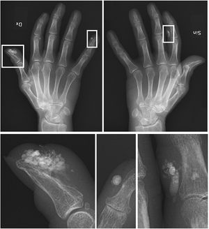 CREST 증후군 환자의 석회증을 보여주는 X-레이