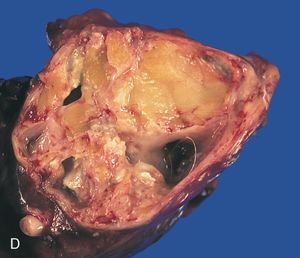 종격동의 성숙 기형종: 절제된 종양의 수평 절단면은 섬유 지방 조직, 석회화 부위, 매끄러운 막으로 덮여 있고 털이 들어 있는 몇 개의 낭성 공간을 보여줍니다. 왼쪽 하단 모서리에는 관련된 B5 기관지가 명확하게 보입니다.