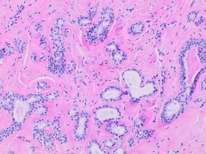 유선 경화성 선증의 조직병리학