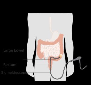 S상결장경 검사