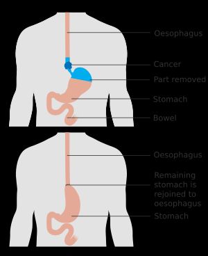 식도와 위의 절제 전후를 보여주는 모식도