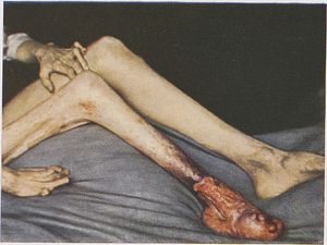 궤양 후 암종을 보이는 사지에서의 전신 경피증