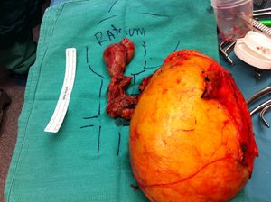 좌측 신장 종양과 하대정맥 혈전이 우심방까지 확장됨