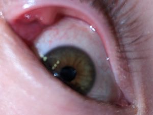 위 눈꺼풀의 내부 다래끼