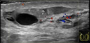 음낭 초음파에서 만성 부고환염 환자의 석회화 및 낭종이 관찰됨.