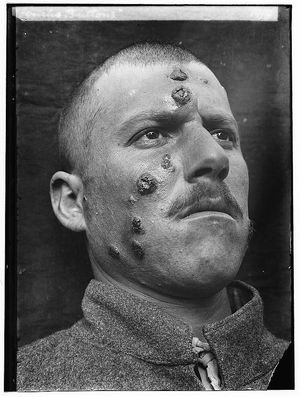 1917년 중동에서 발생한 피부 리슈만편모충증 사례. 당시 고대 도시 예리코 근처에서 발병이 잦아 "예리코 버튼"으로 알려졌다.