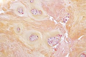 퇴행성 디스크 질환에서 볼 수 있는 섬유연골의 퇴행 현상