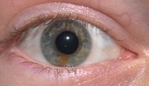 부분 홍채 이색증이 있는 남성 피험자의 오른쪽 눈의 5개 사진 몽타주, 눈의 비틀림 운동 시연