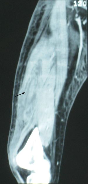 외측광근(화살표)에서 염증성 가닥 형성과 낮은 감쇠를 보여주는 오른쪽 허벅지의 CT 스캔