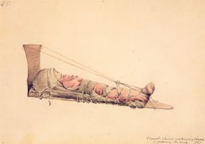 머리 납작하게 만들기 과정을 겪고 있는 치누크족 아이.