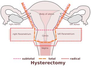 자궁 절제술 유형의 개략도