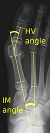 무지 외반 각도(HV)와 중족골 간 각도(IM)를 측정한 X-선 사진