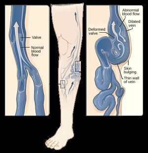다리의 정맥류 형성 과정. 그림 A는 작동하는 판막과 정상적인 혈류를 가진 정상적인 정맥을 보여준다. 그림 B는 변형된 판막, 비정상적인 혈류, 얇고 늘어난 벽을 가진 정맥류를 보여준다. 중간 이미지는 다리에 정맥류가 나타날 수 있는 위치를 보여준다.